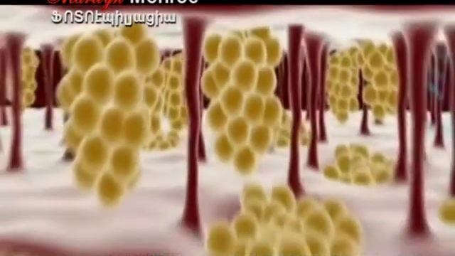 ֆոտոէպիլյացիա/photoepilation_Marily Beauty & Health Center смотреть онлайн