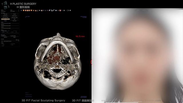 Zygoma reduction didn't help, and I want chin reduction while leaving mandibular angles смотреть онлайн