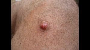 Как лечить и вылечить рак кожи