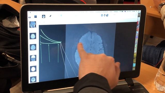 ADCmap на Osirix и Horos: часть 1 - Считаем ADC  из DWI