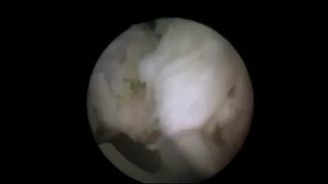 Гольмиевая лазерная энуклеация гиперплазии простаты (HoLEP) смотреть онлайн