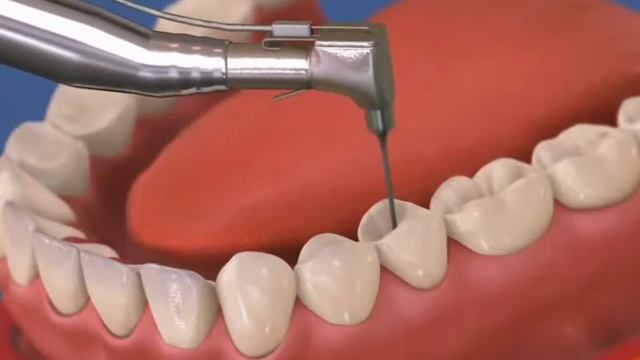 Эндо, ВКВ и коронка премоляр - ДокторСтом г. Краснодар смотреть онлайн