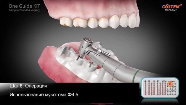 Цифровая имплантация OSSTEM OneGuide смотреть онлайн