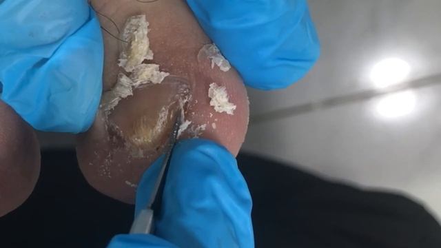 Trim your toenails and dig out a lot of dead skin!【Crazy pedicure room】 смотреть онлайн