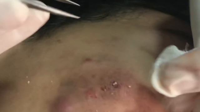 CRAVO GIGANTE !!! #limpezadepele #byglorialeite #jatodeplasma #cravos #cravoseepinhas