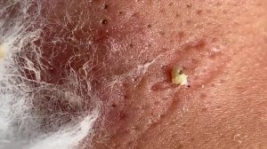 Make your Acne Treatment Huong Da Nang | 448# Hoang Part 1 | acne 2022