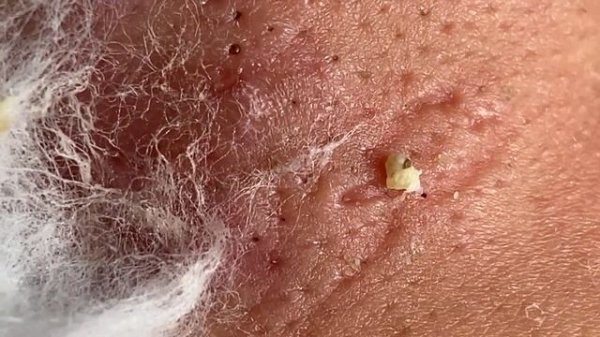 Make your Acne Treatment Huong Da Nang | 448# Hoang Part 1 | acne 2022