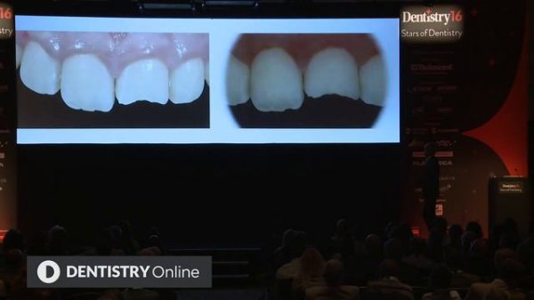 Online Dentistry Show: Lorenzo Vanini – aesthetic dentistry in the anterior teeth