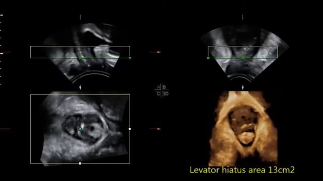 Pelvic organ support changes during pregnancy смотреть онлайн