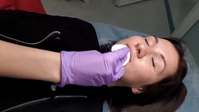 Филлеры для губ