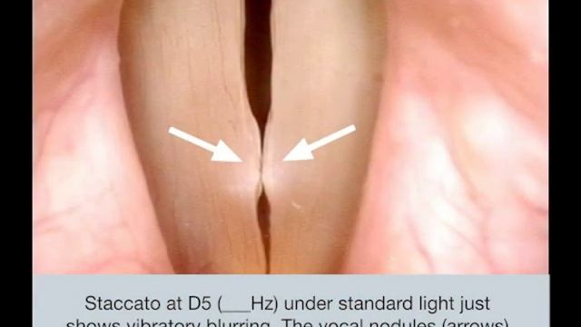 Vocal Cord Nodules - What Do They Sound Like? | Mucosal Chattering смотреть онлайн