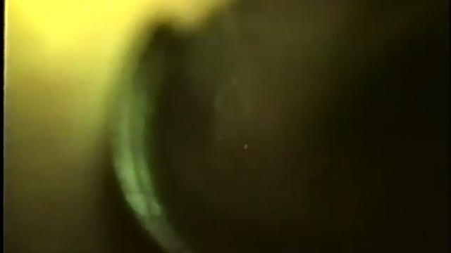 Лазер в оториноларингологии © Laser in otorhinolaryngology смотреть онлайн