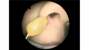 Хоанальный полип. Эндоскопическое удаление полипа носа шейвером ЛОР-хирург ЛОР центр в Москве