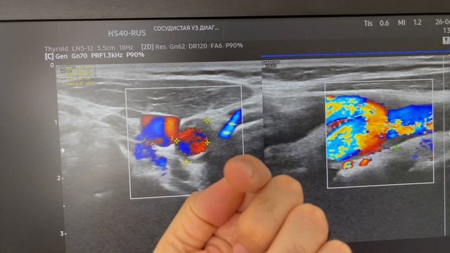 Исследование сонных артерий. Атеросклероз. Узи сосудов. Сосудистый хирург. Флеболог Москва смотреть онлайн