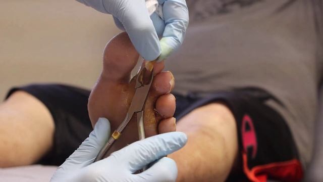 The FAST Diabetic Foot Ulcer Fix! (Type 2 Diabetes +Neuropathy)