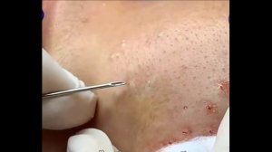 Удаление черных точек 2021 - Remoção de cravo 2021 - Pimple Popping 2021 -Blackhead Removal 2021