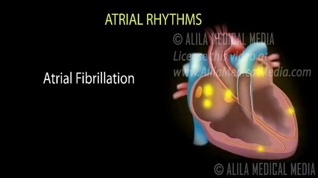 Cardiac Arrhythmias, Animation смотреть онлайн