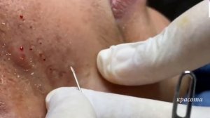 Новое Выдавливание прыщей #03 |  Как Избавиться от Угрей Раз и Навсегда