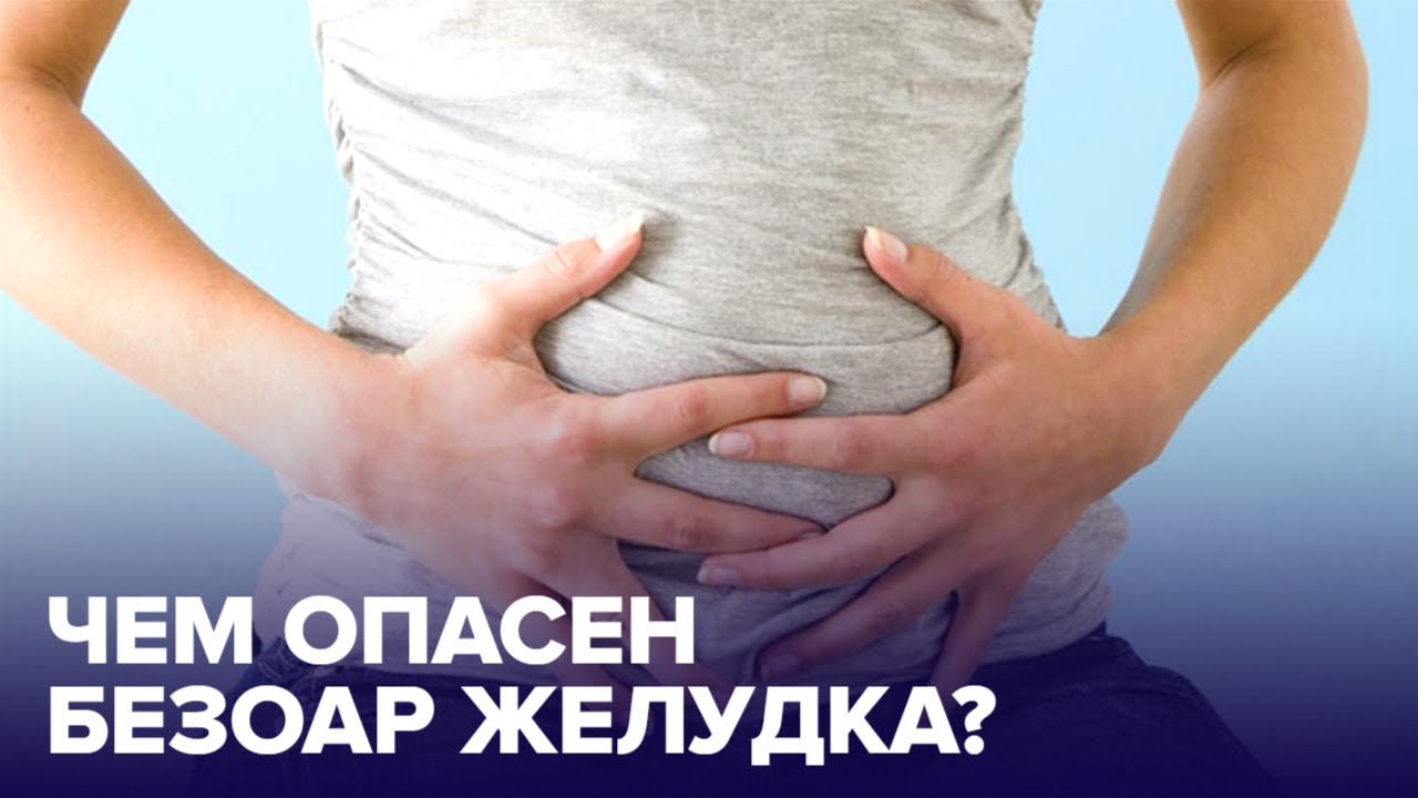 БЕЗОАР или что можно обнаружить в нашем желудке? смотреть онлайн