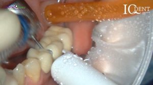 Распиливание металлокерамического моста за 2 минуты бором IQdent