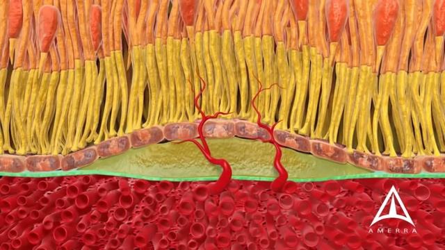 How Macular Degeneration Affects Your Vision - 3D animation смотреть онлайн