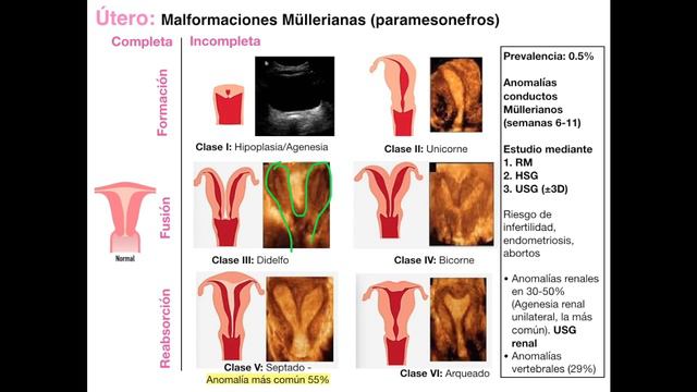 11.3 - Imagenología Del útero Y Enfermedad Pélvica Inflamatoria