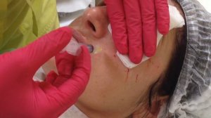 Мезоботокс. Лифтинг кожи лица после 50 лет.