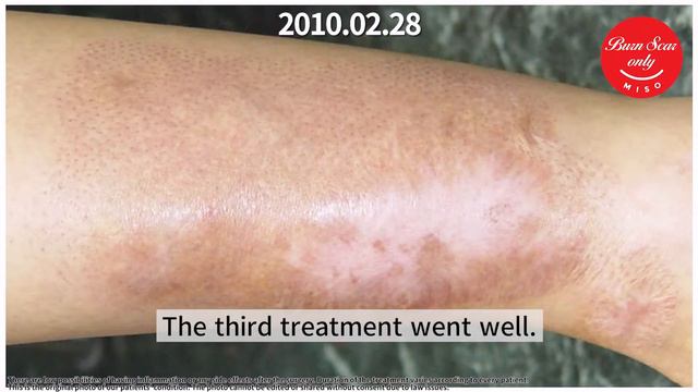 Black, White, Red Extreme colours burn scars treatment history смотреть онлайн