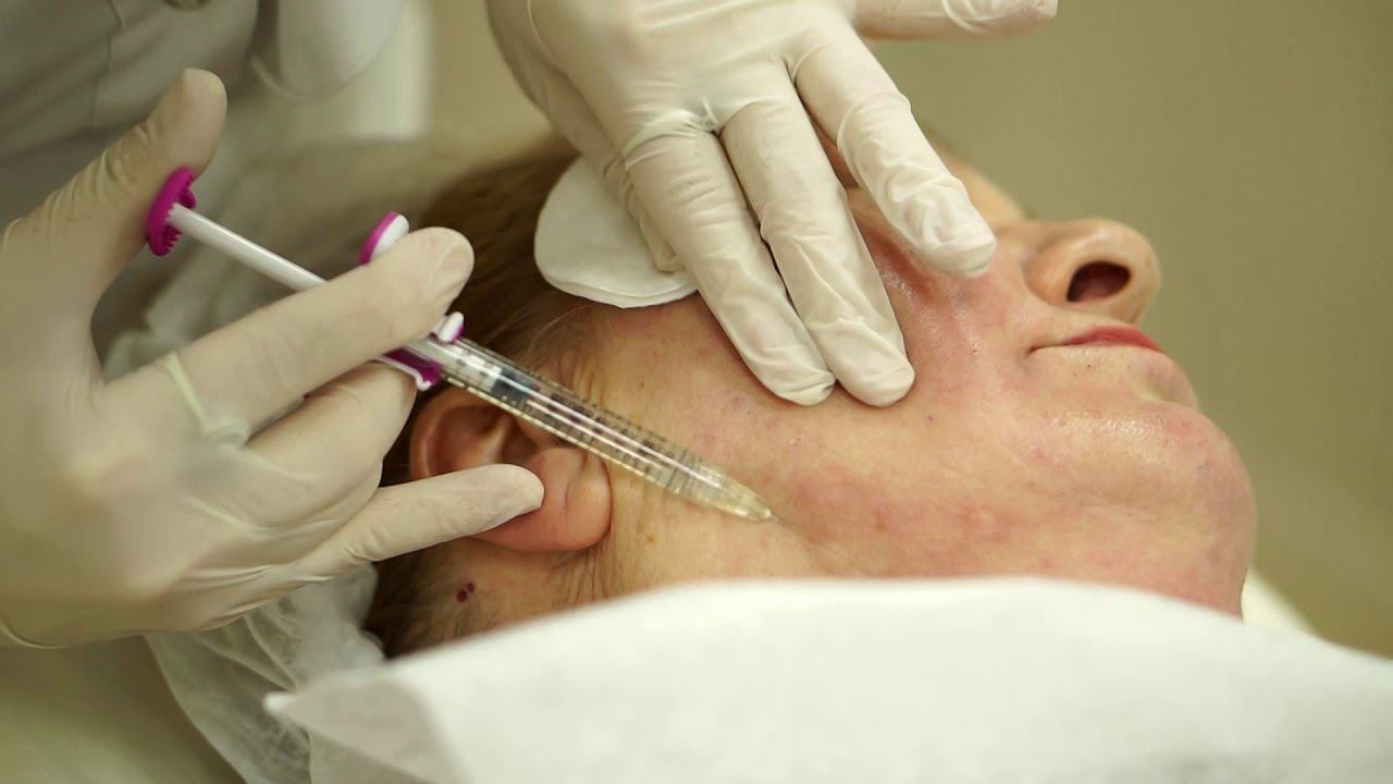 Контурная пластика препаратом Juvederm Volbella. смотреть онлайн