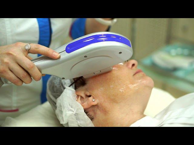 Фотоомоложение. смотреть онлайн