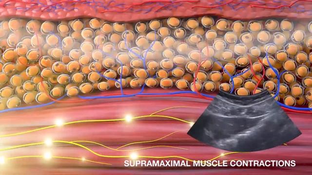 Альтернатива спортзалу — EMSculpt