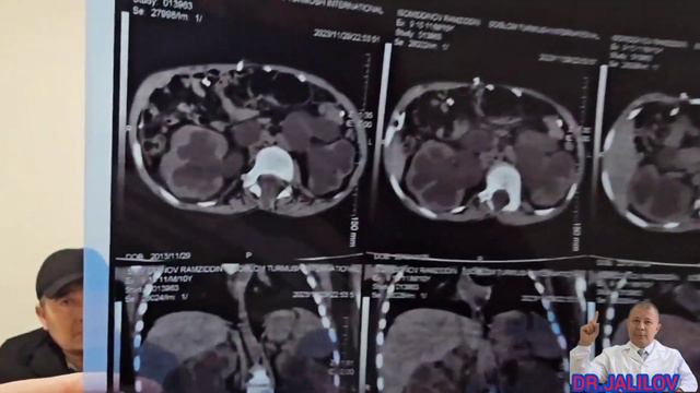 Что такое шунт в голове при гидроцефалии? смотреть онлайн