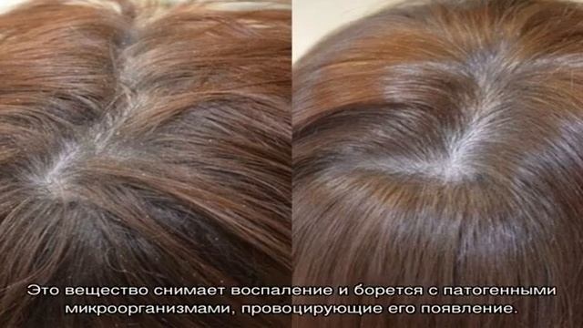 Стоит ли покупать шампунь Скин Кап для лечения перхоти или можно выбрать аналоги дешевле