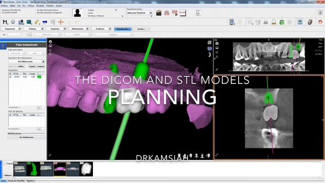 SHORTY implant in Guided Implant Surgery In A Molar Region смотреть онлайн