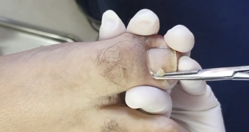 Вросший ноготь???⚠️?? смотреть онлайн