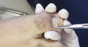 Вросший ноготь???⚠️??