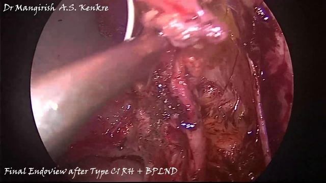 Final Endoview after Radical Hysterectomy and Lymph node dissection смотреть онлайн