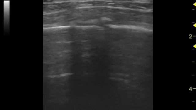 Перелом ребра смотреть онлайн