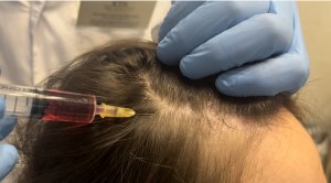 Мезотерапия для волос.