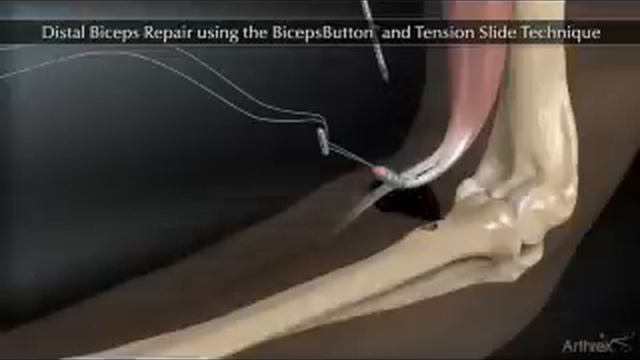 Distal Biceps Repair Animation смотреть онлайн