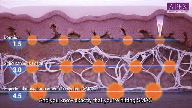 Which one is the best face lifting technique? Ulthera, Thermage or Filler injection? смотреть онлайн