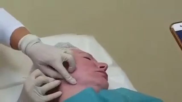 Постановка нитей Resorblift в субментальной области смотреть онлайн