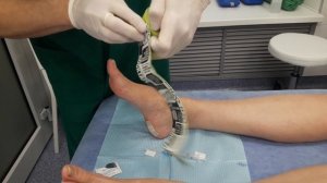 Пяточная шпора - лечение блокадой и кинезиотейпированием