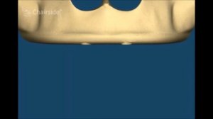 Все виды имплантации зубов