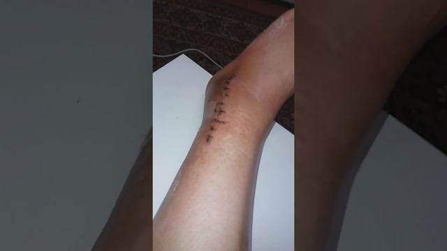 Перелом лодыжки со смещением смотреть онлайн
