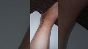 Перелом лодыжки со смещением