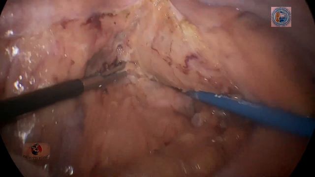 Laparoscopic (APR) abdominoperineal resection/Лап. брюшно-промежностная экстирпация прямой кишки смотреть онлайн