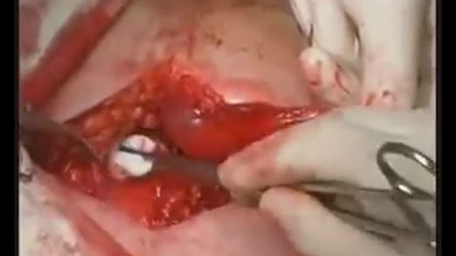 методы лечения паховых грыж смотреть онлайн