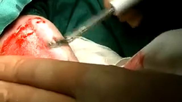 Versajet детский ожог смотреть онлайн