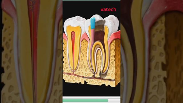 Воспаление корня зуба наглядно в программном обеспечении #vatech #стоматология #зубы смотреть онлайн